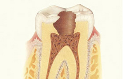 Лечение каналов зуба, пломбировка каналов