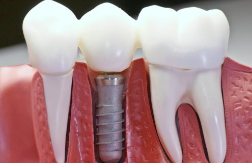 Импланты зубов, имплантация зубов