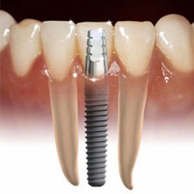 Имплантация зубов, импланты зубов